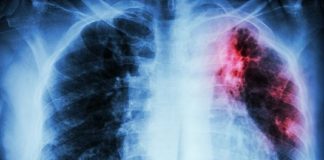 Tuberculose pulmonaire et primo-infection tuberculeuse