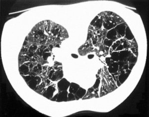 Poumon multikystique et kystes pulmonaires multiples