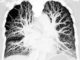Préservation ischémique du poumon