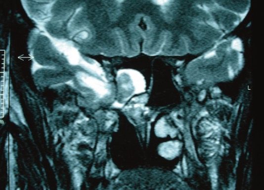 Rhinorrhée cérébrospinale