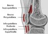 Ruptures de l'appareil extenseur du genou