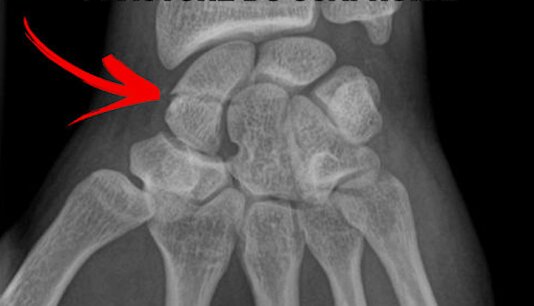 Séquelles des fractures des os du carpe