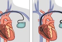 Stimulateurs cardiaques