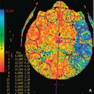 Nouvelles techniques d'imagerie scanner et IRM pour l'étude des vaisseaux cervicoencéphaliques