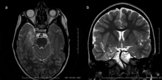Nouvelles techniques IRM du parenchyme cérébral
