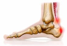 Pathologie du tendon d'Achille : tendinopathies - ruptures - plaies (Suite)