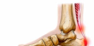 Pathologie du tendon d'Achille : tendinopathies - ruptures - plaies (Suite)