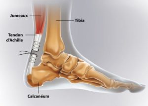 Pathologie du tendon d'Achille : tendinopathies - ruptures - plaies