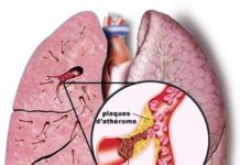 Tomodensitométrie spiralée dans le diagnostic de l’embolie pulmonaire aiguë