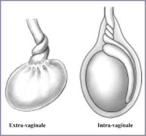 Torsion du cordon spermatique