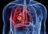Tumeurs bénignes des bronches, du poumon et du thorax