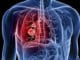 Tumeurs bénignes des bronches, du poumon et du thorax