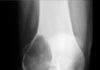 Tumeurs des os. Généralités diagnostiques (biopsie et anatomie pathologique)