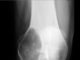 Tumeurs des os. Généralités diagnostiques (biopsie et anatomie pathologique)