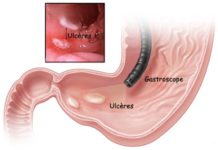 Ulcères gastrique (UG) et duodénal (UD)